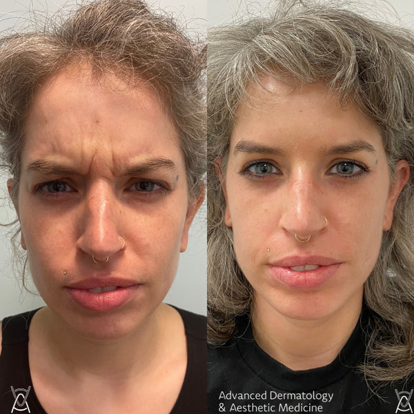 BOTOX/DYSPORT