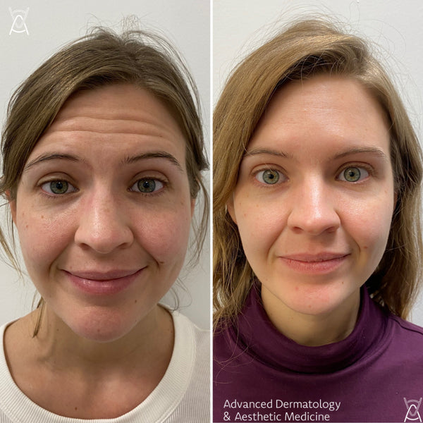 BOTOX/DYSPORT