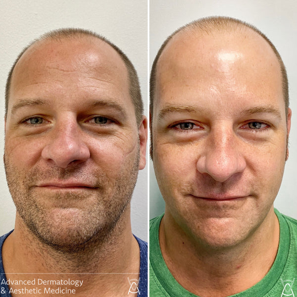 BOTOX/DYSPORT