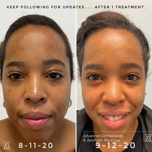 MICRONEEDLING