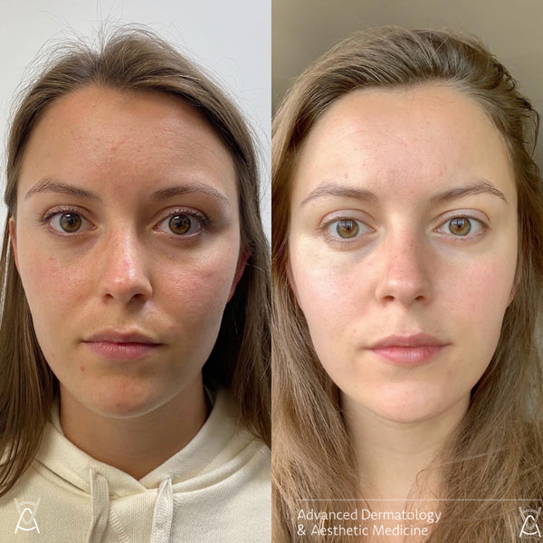 MICRONEEDLING