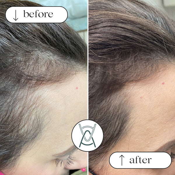 HAIR PRP