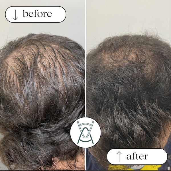 HAIR PRP